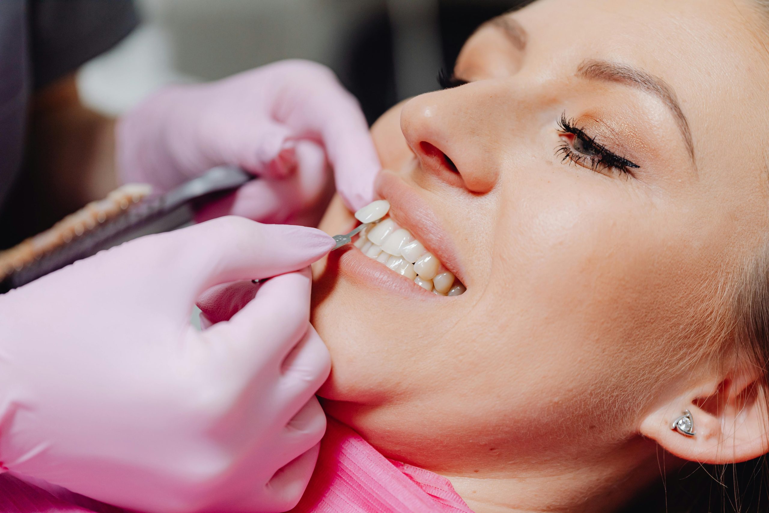 Types of veneers