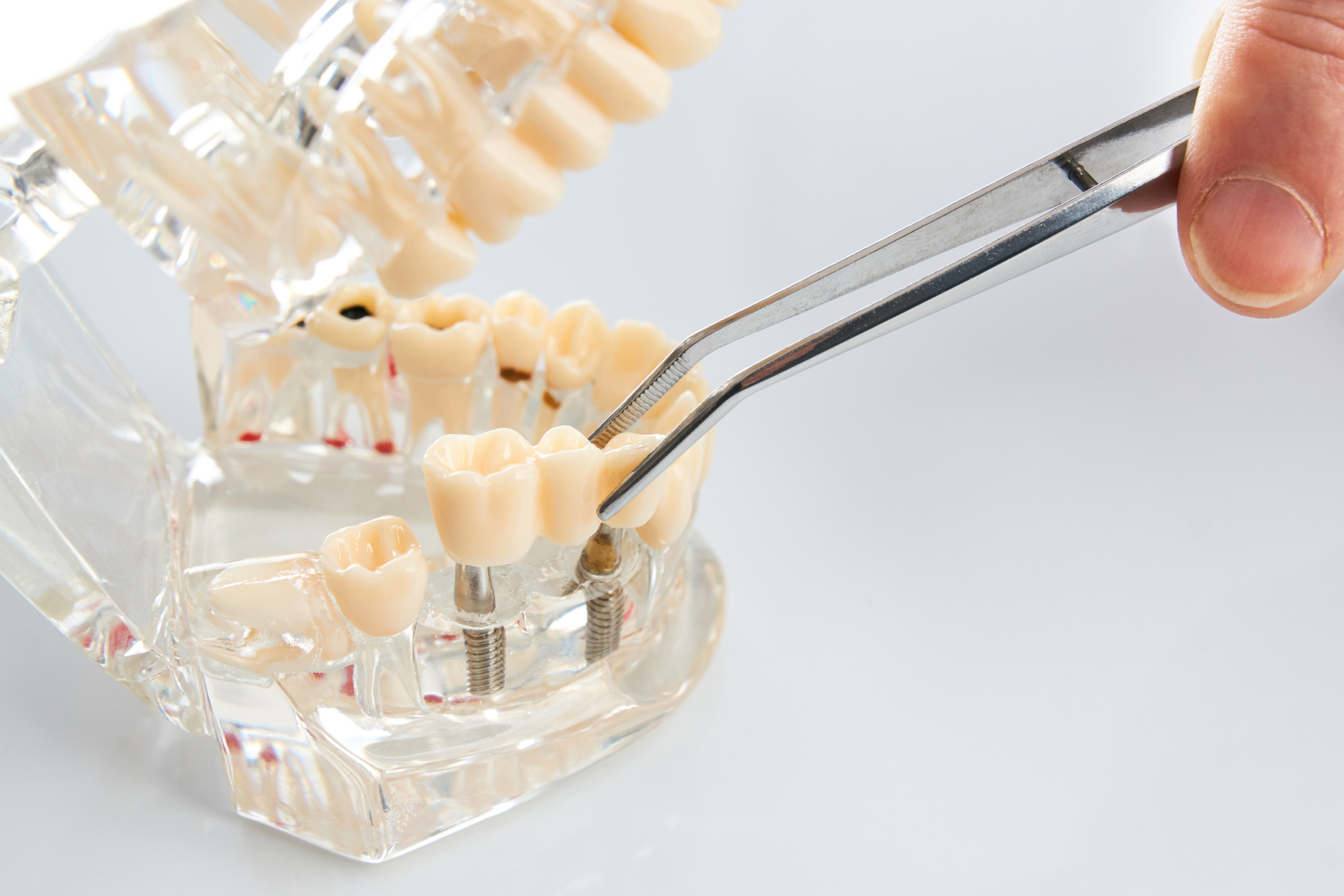 Veneers Veneers