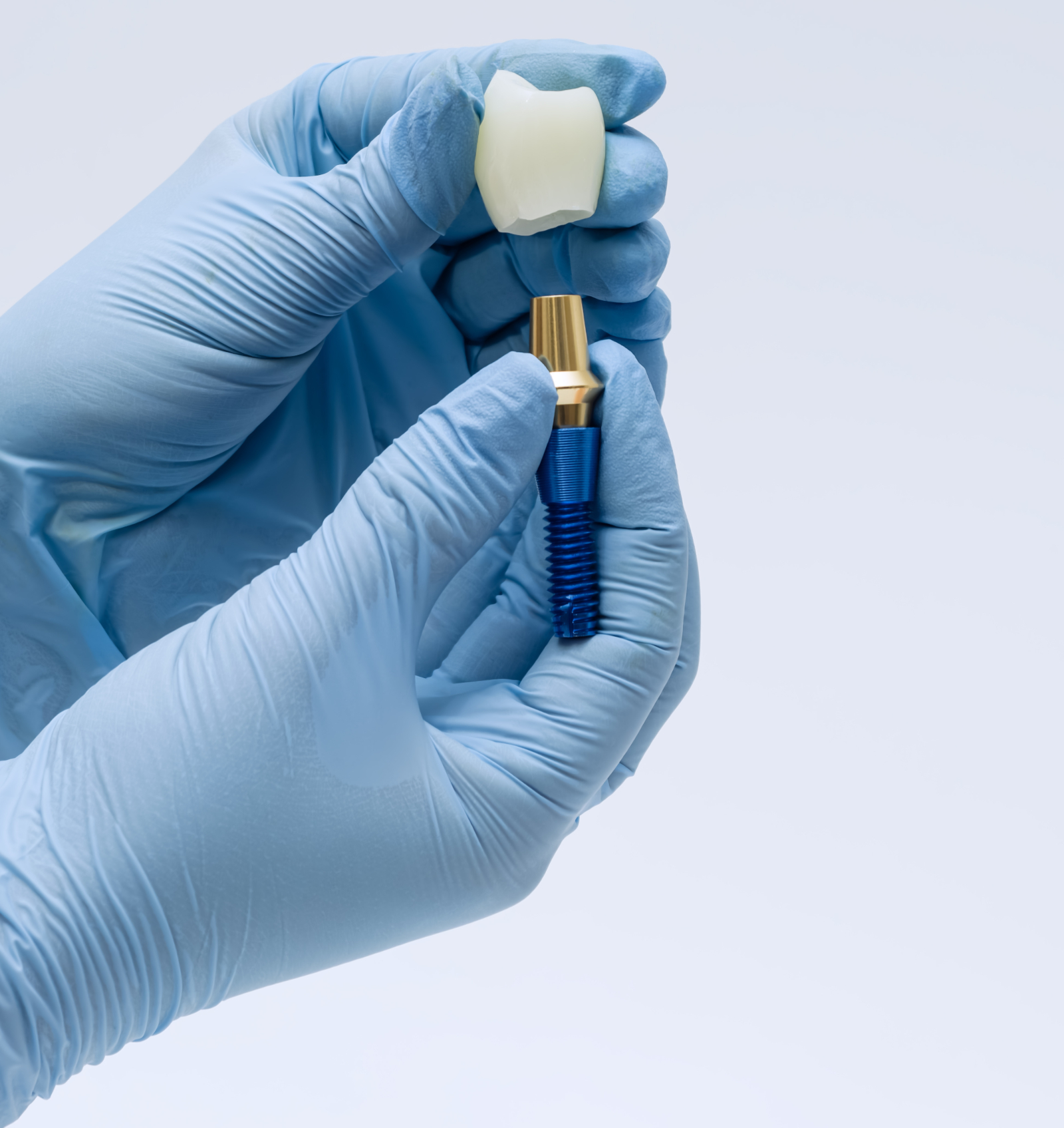 Veneers Veneers